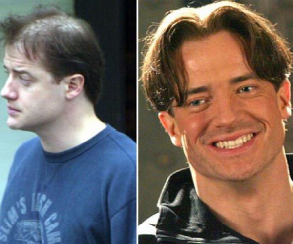 Brendan Fraser Saç Ektirdi