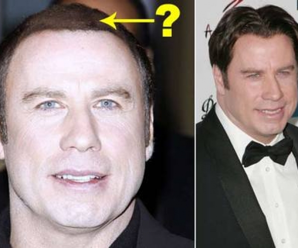 John Travolta Saç Mı Ektirdi?