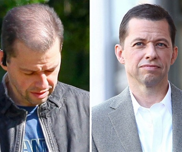 Jon Cryer Saç Ektirdi