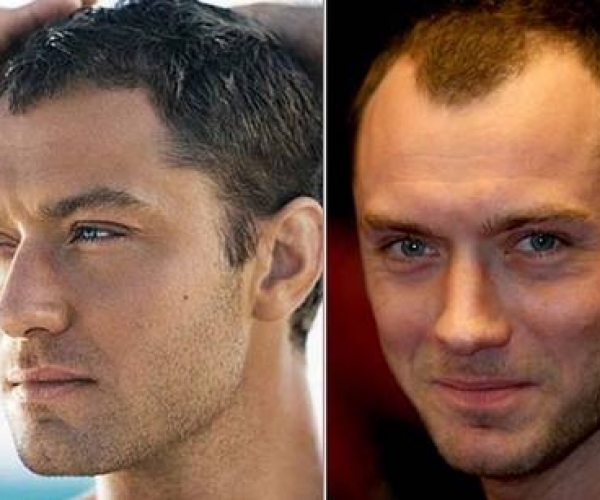 Jude Law Saç Ektirdi