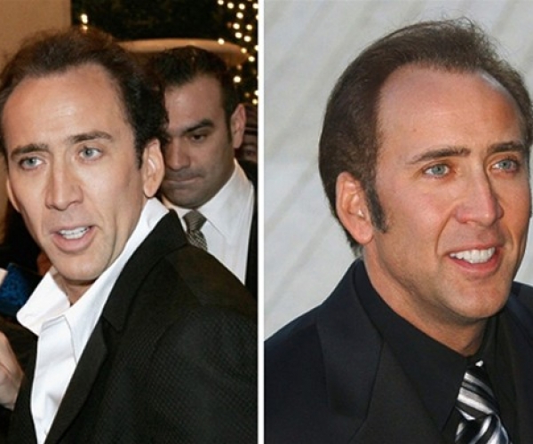 Nicolas Cage Saç Ektirdi