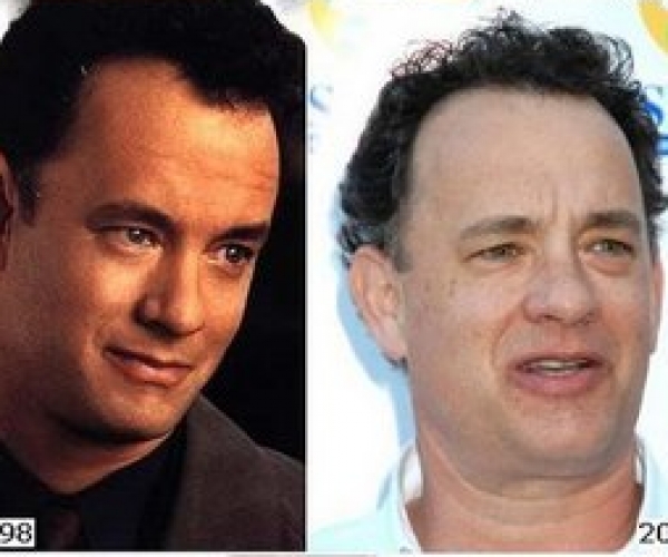 Tom Hanks Saç Ektirdi